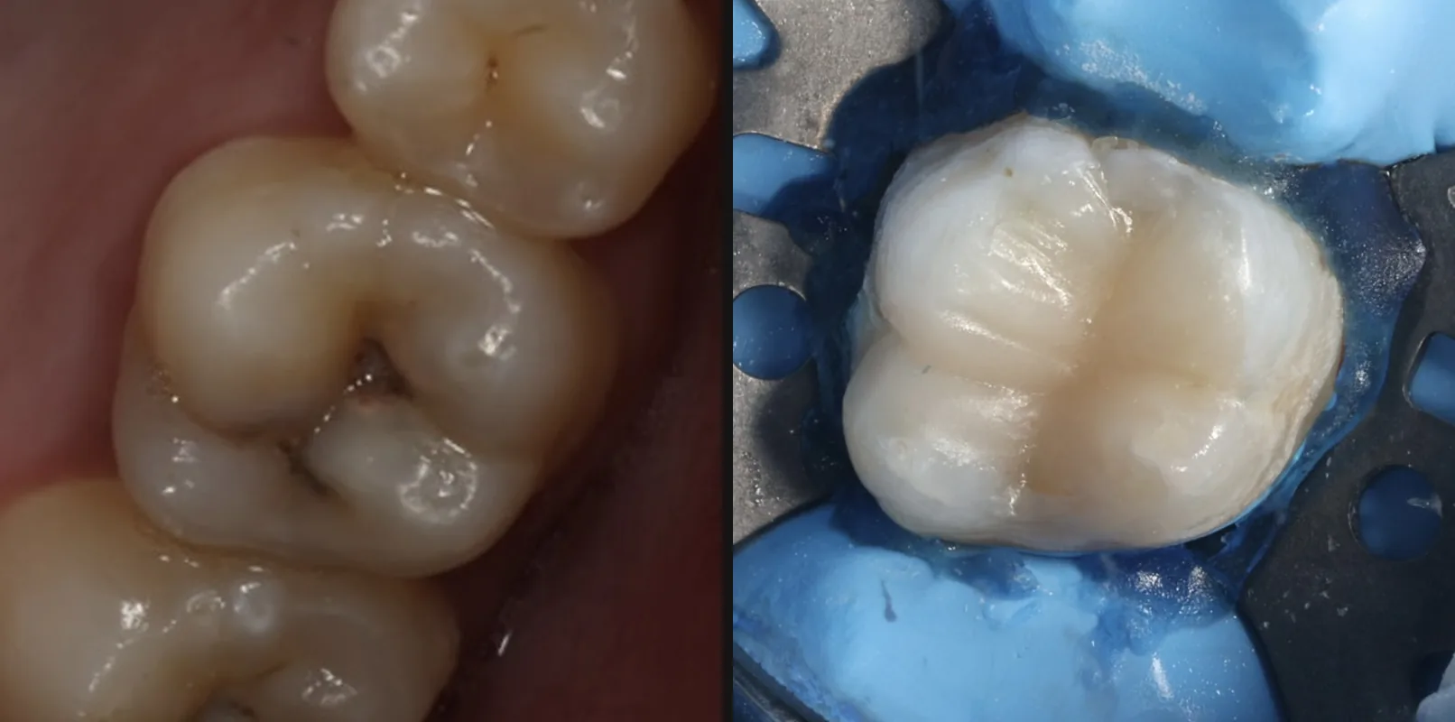 The same molar: before with dark decay in the grooves, after restored with a tooth-colored filling